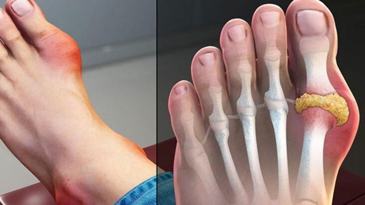 Những yếu tố nào gây nên các cơn đau dữ dội đối với người bệnh gout? - Ảnh 1. Những yếu tố nào gây nên các cơn đau dữ dội đối với người bệnh gout? - Ảnh 1.