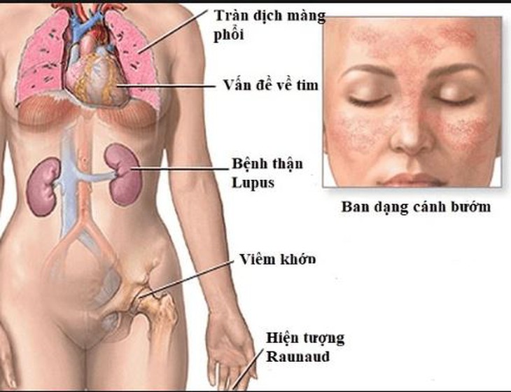 Bước ngoặt mới cho bệnh nhân viêm thận lupus - Ảnh 1.