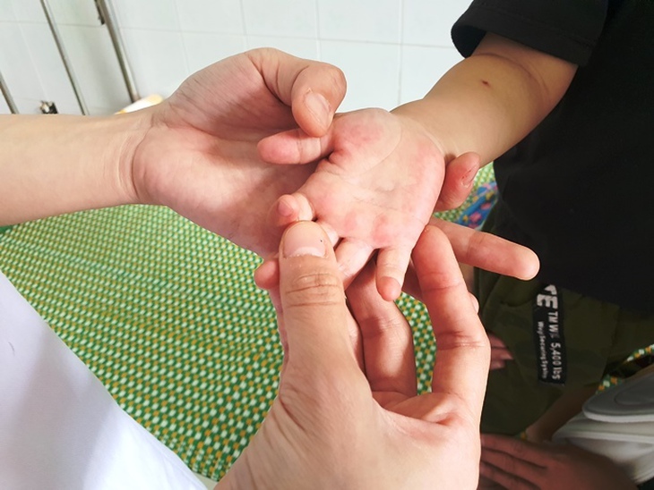Trẻ mắc tay chân miệng do virus EV71 dễ chuyển nặng: khả năng tồn tại và lây lan của virus là bao lâu?- Ảnh 1. Trẻ mắc tay chân miệng do virus EV71 dễ chuyển nặng: khả năng tồn tại và lây lan của virus là bao lâu?- Ảnh 1.