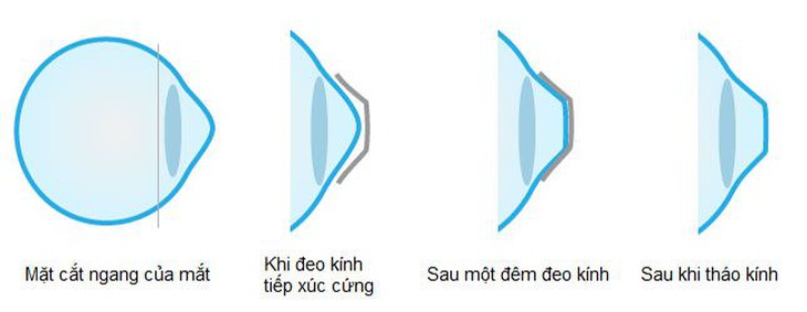 Dấu hiệu nhận biết cận thị và các phương pháp điều trị hiệu quả - Ảnh 3.