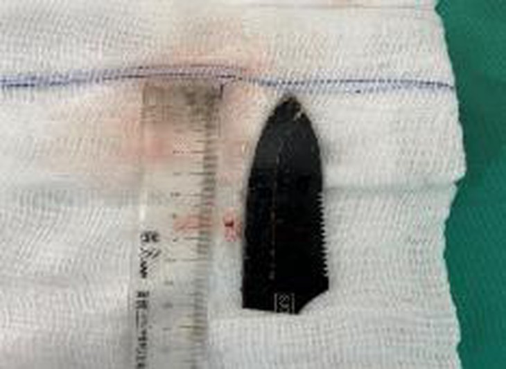 Cứu thanh niên còn nguyên lưỡi dao 10cm trong bả vai - Ảnh 2. Cứu thanh niên còn nguyên lưỡi dao 10cm trong bả vai - Ảnh 2.