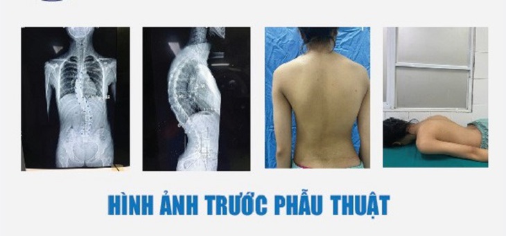 Hành trình tìm lại dáng vóc của nữ sinh 15 tuổi bị vẹo cột sống do ngồi học sai tư thế - Ảnh 1.