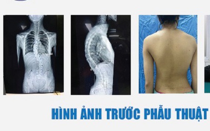 Hành trình tìm lại dáng vóc cho nữ sinh 15 tuổi bị vẹo cột sống do ngồi học sai tư thế