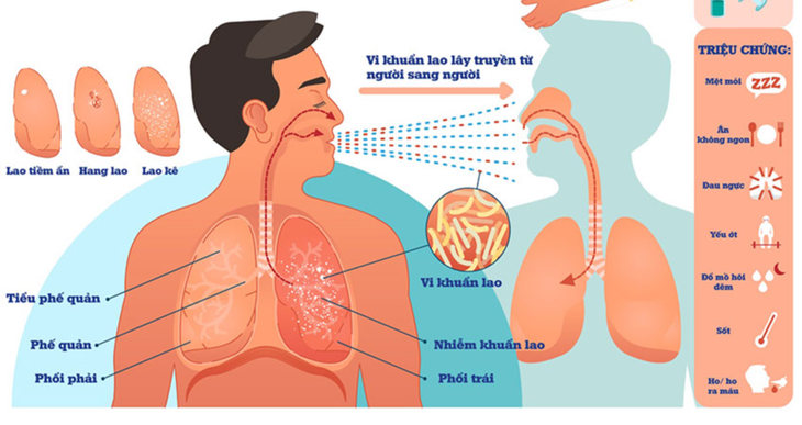 Nguồn lây bệnh lao cho người lành chủ yếu là người bệnh mắc lao phổi, đặc biệt là người bệnh có vi khuẩn tìm thấy được bằng xét nghiệm đờm soi kính trực tiếp. Nguồn lây bệnh lao cho người lành chủ yếu là người bệnh mắc lao phổi, đặc biệt là người bệnh có vi khuẩn tìm thấy được bằng xét nghiệm đờm soi kính trực tiếp.