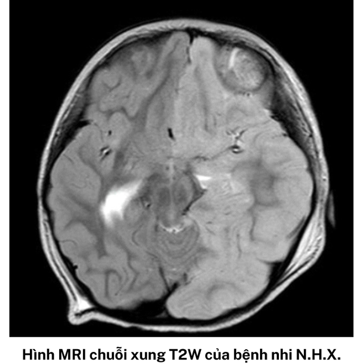 TP. HCM: Cứu sống ngoạn mục 2 trẻ nguy kịch do bệnh não cấp hiếm gặp - Ảnh 2.