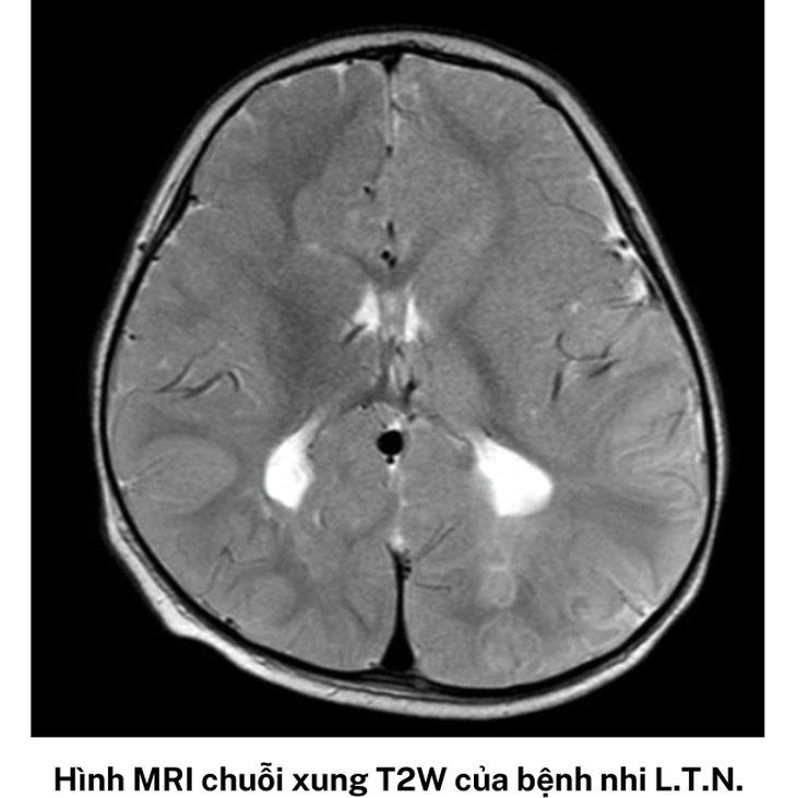 TP. HCM: Cứu sống ngoạn mục 2 trẻ nguy kịch do bệnh não cấp hiếm gặp - Ảnh 1.