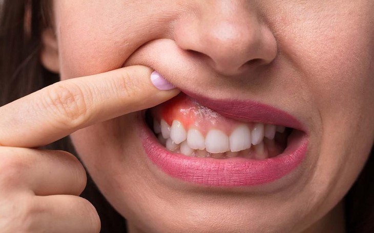 Biểu hiện viêm lợi và cách phòng ngừa hiệu quả