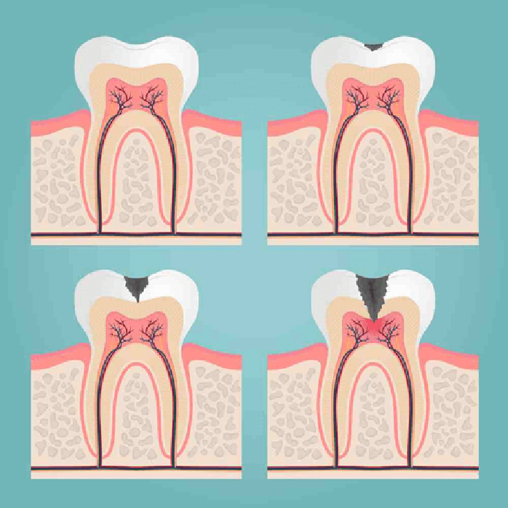 Biến chứng nguy hiểm của viêm tuỷ răng- Ảnh 1.