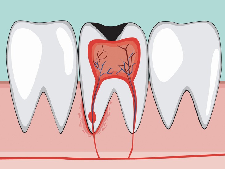 Những biến chứng nguy hiểm của viêm tủy răng - Ảnh 1. Những biến chứng nguy hiểm của viêm tủy răng - Ảnh 1.