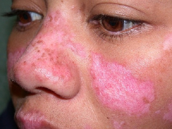 Biểu hiện của bệnh lupus ban đỏ hệ thống và cách điều trị - Ảnh 1.