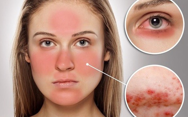 Biểu hiện của bệnh lupus ban đỏ hệ thống và cách điều trị
