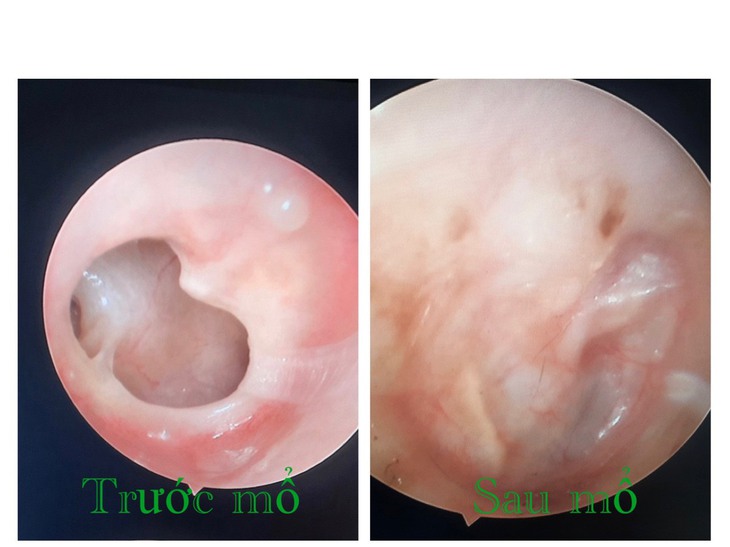 Phẫu thuật chỉnh hình xương con theo phương pháp tự thân: chữa dứt điểm điếc, nghe kém - Ảnh 2. Phẫu thuật chỉnh hình xương con theo phương pháp tự thân: chữa dứt điểm điếc, nghe kém - Ảnh 2.