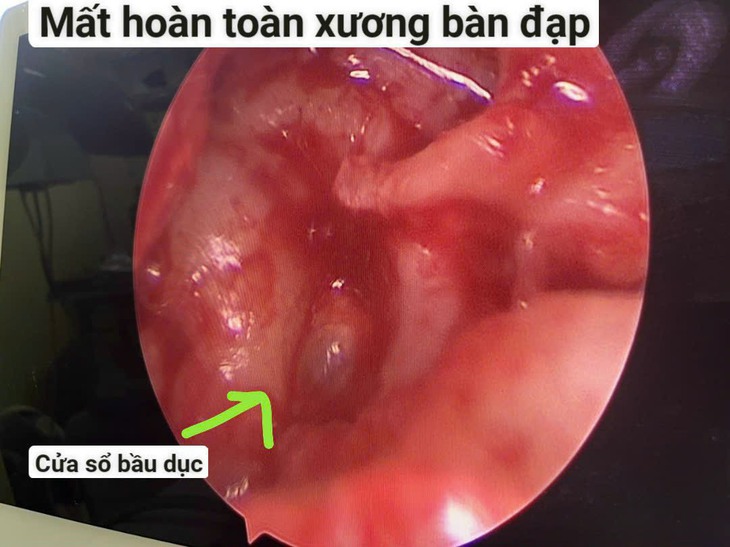 Phẫu thuật chỉnh hình xương con theo phương pháp tự thân: chữa dứt điểm điếc, nghe kém - Ảnh 4. Phẫu thuật chỉnh hình xương con theo phương pháp tự thân: chữa dứt điểm điếc, nghe kém - Ảnh 4.