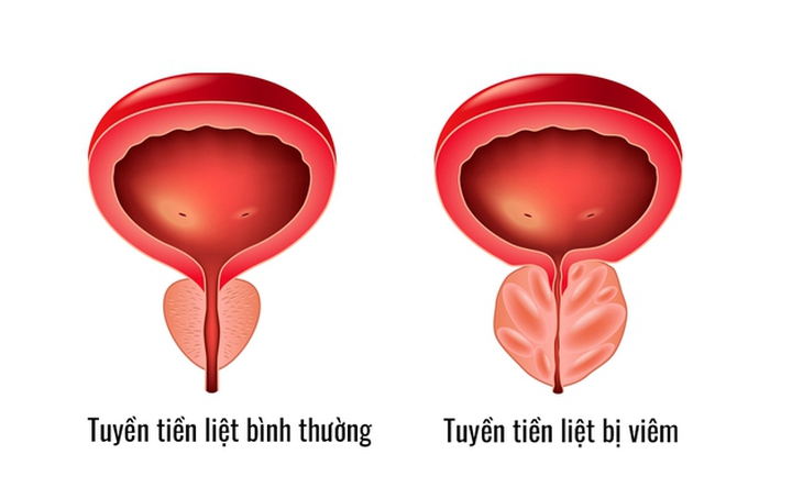 Đau tầng sinh môn nam thanh niên phát hiện viêm tiền liệt tuyến - Ảnh 2. Đau tầng sinh môn nam thanh niên phát hiện viêm tiền liệt tuyến - Ảnh 2.