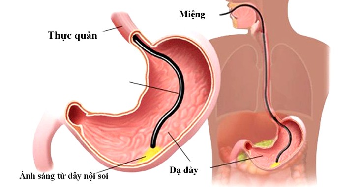 Phương pháp nội soi rất an toàn, ảnh hưởng duy nhất có thể gặp phải là xây xát niêm mạc, gây chảy máu, nhiễm trùng, rách thủng.  Ảnh minh họa