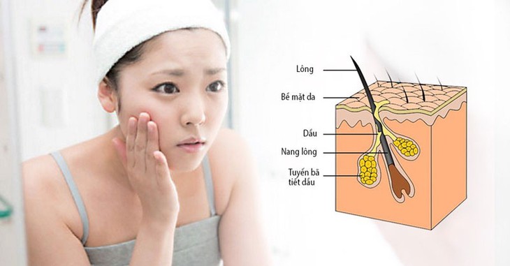 6 nguyên nhân gây da nhờn và cách khắc phục tại nhà - Ảnh 2.