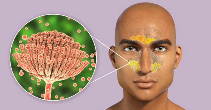 Có 2 loại viêm xoang do nấm là : viêm không xâm lấn và viêm xâm lấn. Ảnh minh họa Có 2 loại viêm xoang do nấm là : viêm không xâm lấn và viêm xâm lấn. Ảnh minh họa