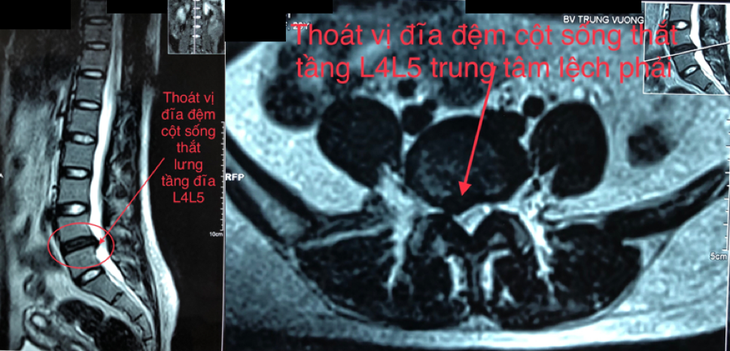Nhiều người trẻ sống khổ vì thoát vị đĩa đệm - Ảnh 1. Nhiều người trẻ sống khổ vì thoát vị đĩa đệm - Ảnh 1.