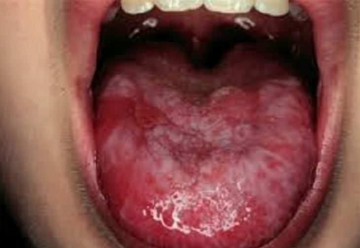 Ung thư lưỡi có điều trị khỏi hoàn toàn và phòng ngừa được không? - Ảnh 2.