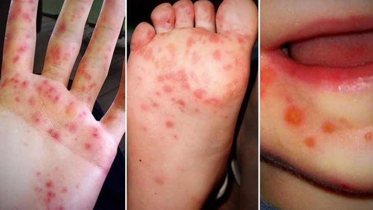Y tế cơ sở lọc máu cứu kịp thời bệnh nhân tay chân miệng nặng - Ảnh 3. Y tế cơ sở lọc máu cứu kịp thời bệnh nhân tay chân miệng nặng - Ảnh 3.