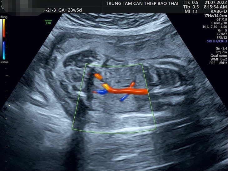 Chuyện giờ mới kể về ca bệnh đột biến gene ACE lần đầu tiên được phát hiện tại Việt Nam - Ảnh 1. Chuyện giờ mới kể về ca bệnh đột biến gene ACE lần đầu tiên được phát hiện tại Việt Nam - Ảnh 1.