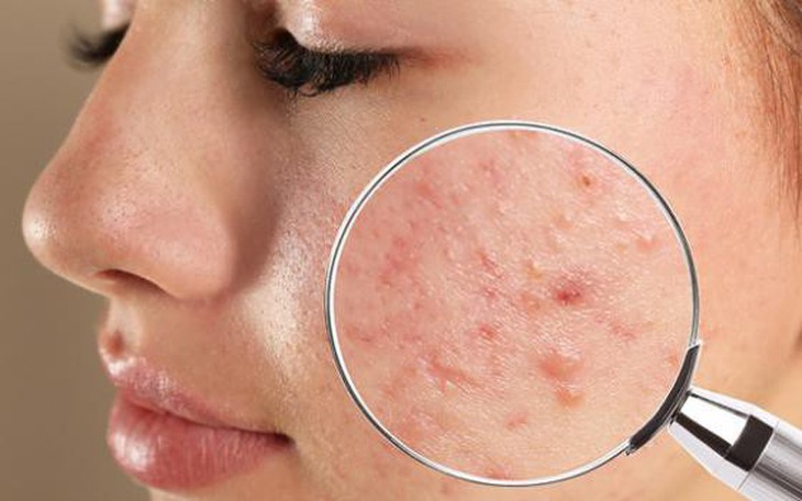 Mụn do nội tiết tố xử lý như thế nào?