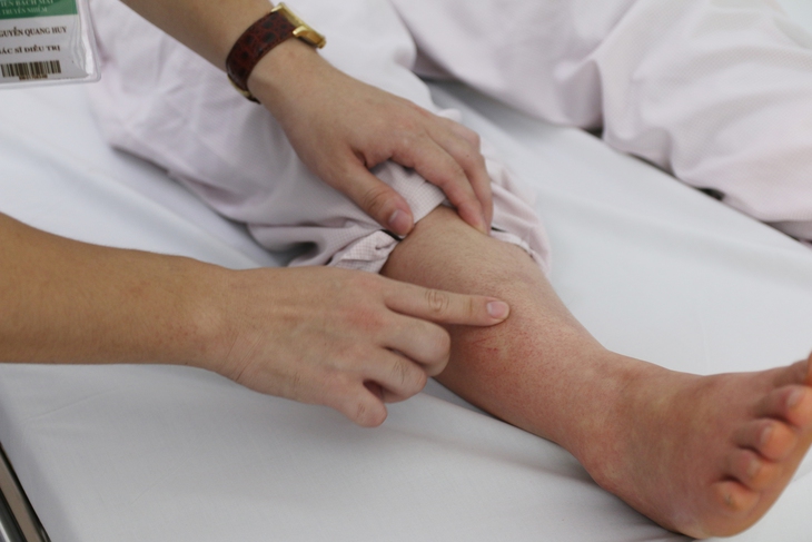 Những câu hỏi thường gặp về sốt xuất huyết- Ảnh 1.