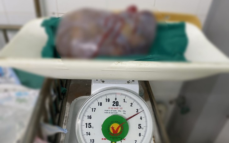 Bụng to bất thường, cụ bà 77 tuổi phát hiện có khối u ác buồng trứng nặng 3,3kg