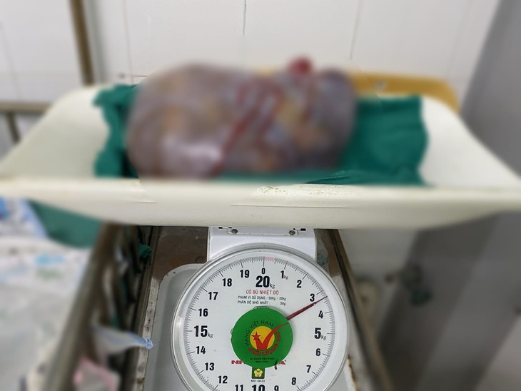 Bụng to bất thường, cụ bà 77 tuổi phát hiện có khối u ác buồng trứng nặng 3,3kg - Ảnh 1. Bụng to bất thường, cụ bà 77 tuổi phát hiện có khối u ác buồng trứng nặng 3,3kg - Ảnh 1.