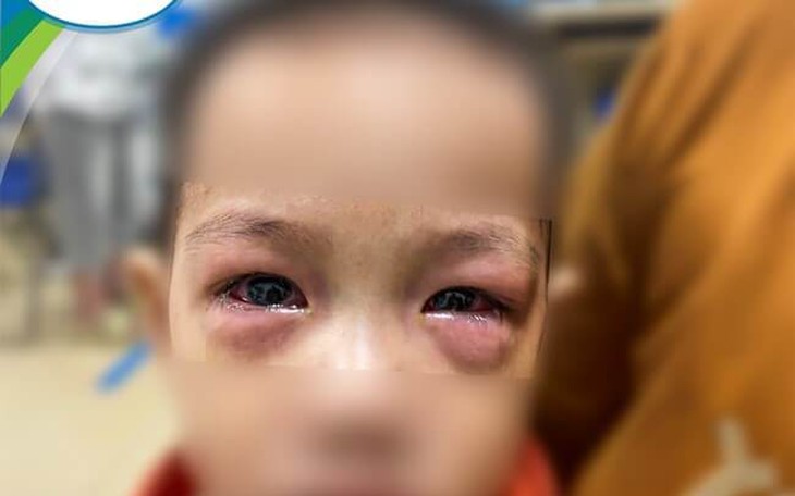 Nhiều trẻ gặp biến chứng nặng do đau mắt đỏ, chuyên gia khuyến cáo gì?