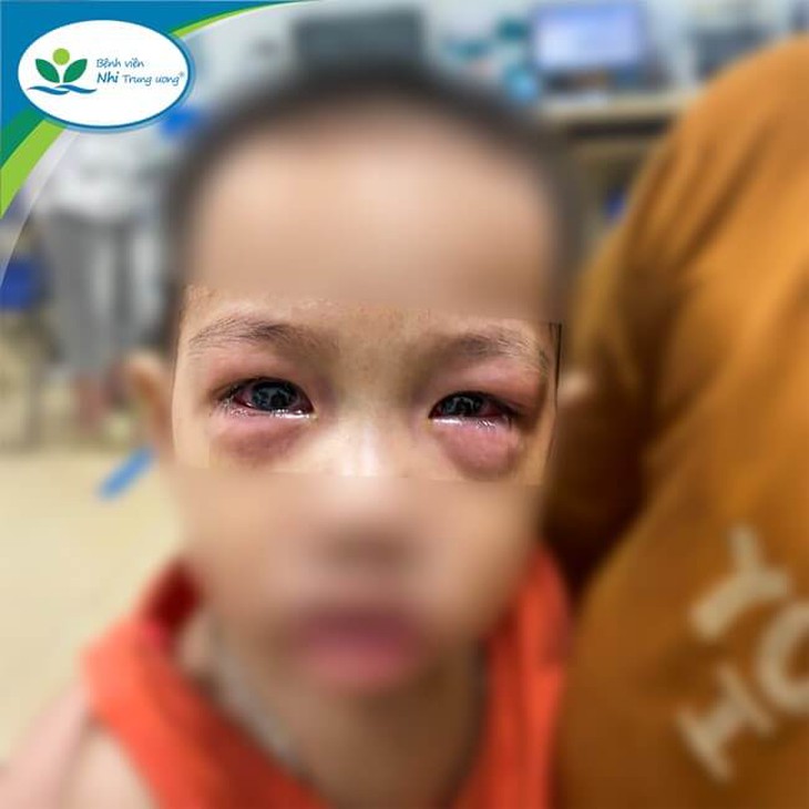 Nhiều trẻ gặp biến chứng nặng do đau mắt đỏ, chuyên gia khuyến cáo gì? - Ảnh 1. Nhiều trẻ gặp biến chứng nặng do đau mắt đỏ, chuyên gia khuyến cáo gì? - Ảnh 1.
