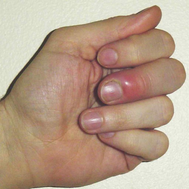 Tự nặn mụn ở tay, nam thanh niên 20 tuổi nhập viện cảnh giác với căn bệnh này - Ảnh 1.