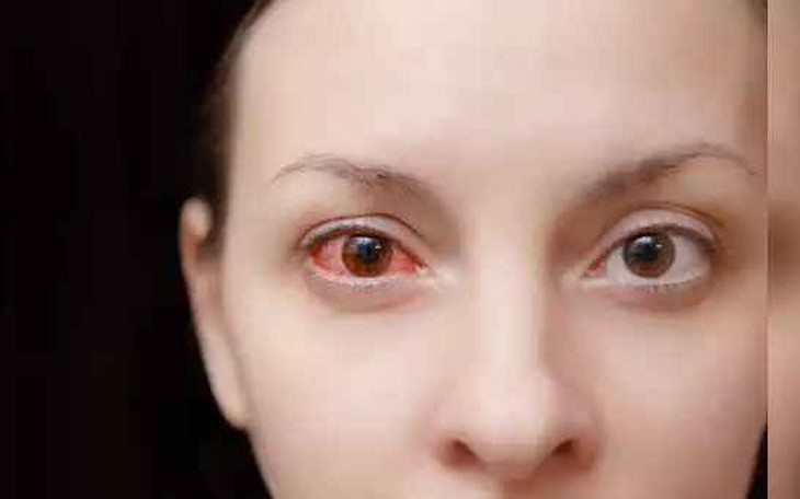 Đau mắt đỏ ăn rau muống, thịt mỡ, đồ tanh khiến bệnh lâu khỏi?