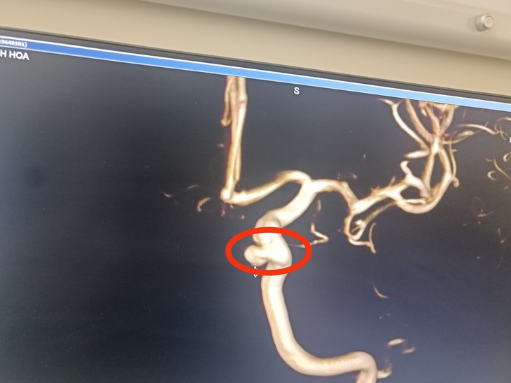 Giảm những cơn đau đầu nhờ đặt stent chuyển dòng điều trị túi phình lớn động mạch não - Ảnh 1.