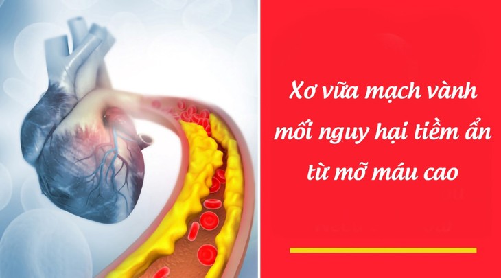Hậu quả nguy hiểm của mỡ máu cao: Cẩn trọng trước khi quá muộn! - Ảnh 1.