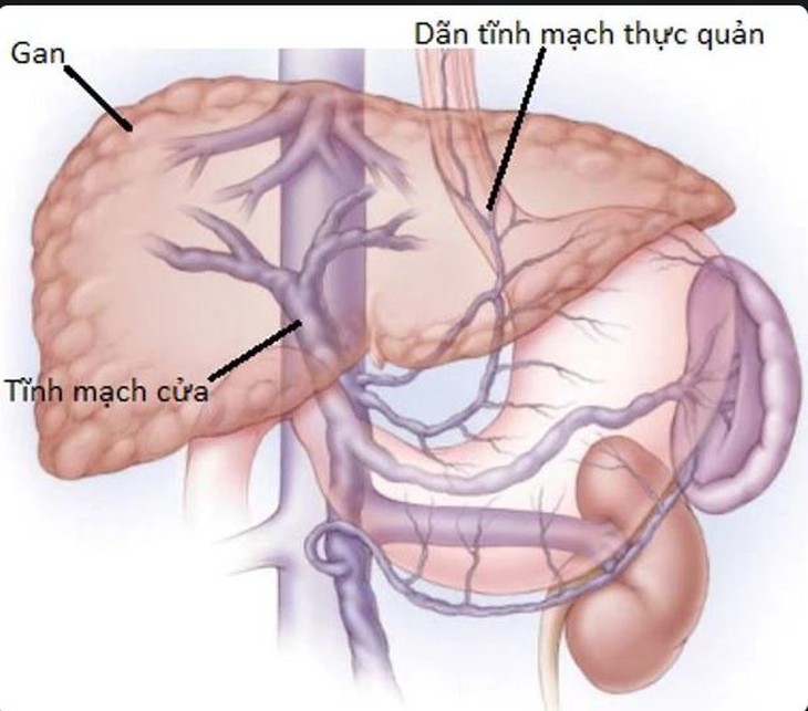 Bệnh nhân sốc mất máu do giãn vỡ tĩnh mạch thực quản bởi nguyên nhân gì? - Ảnh 1. Bệnh nhân sốc mất máu do giãn vỡ tĩnh mạch thực quản bởi nguyên nhân gì? - Ảnh 1.