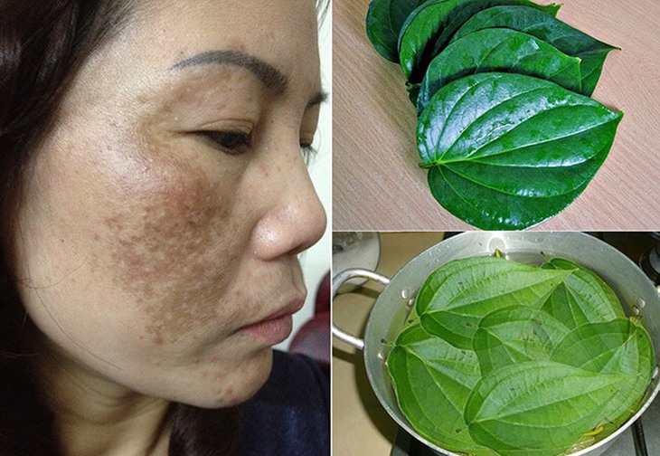 Da loang lổ do đắp lá trầu không chữa nám, làm trắng da - Ảnh 1.