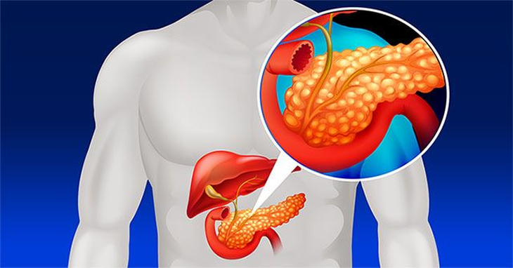 5 loại thực phẩm cần tránh tiêu thụ hằng ngày để bảo vệ tuyến tụy - Ảnh 2.
