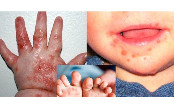 3 bài thuốc Y học cổ truyền  hỗ trợ trị tay chân miệng