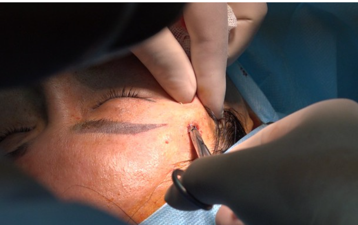 Tiêm filler ở cơ sở "chui", một phụ nữ suýt bị mù mắt - Ảnh 1.