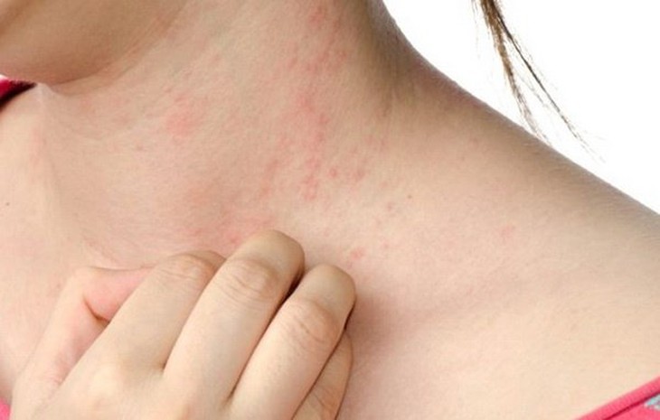 Dị ứng thực phẩm xảy ra khi hệ thống miễn dịch của cơ thể có nhiệm vụ chống lại nhiễm trùng lại nhầm lẫn, coi thực phẩm là kẻ gây hại và kích hoạt đáp ứng chống lại. Dị ứng thực phẩm xảy ra khi hệ thống miễn dịch của cơ thể có nhiệm vụ chống lại nhiễm trùng lại nhầm lẫn, coi thực phẩm là kẻ gây hại và kích hoạt đáp ứng chống lại.