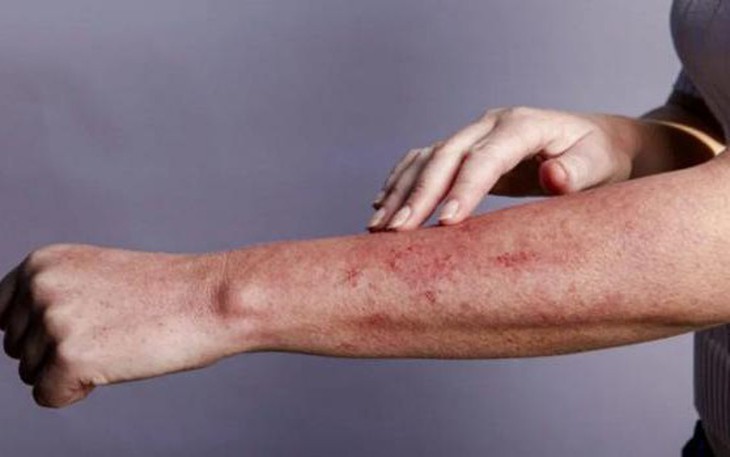 Các tình trạng da liên quan đến HIV/AIDS