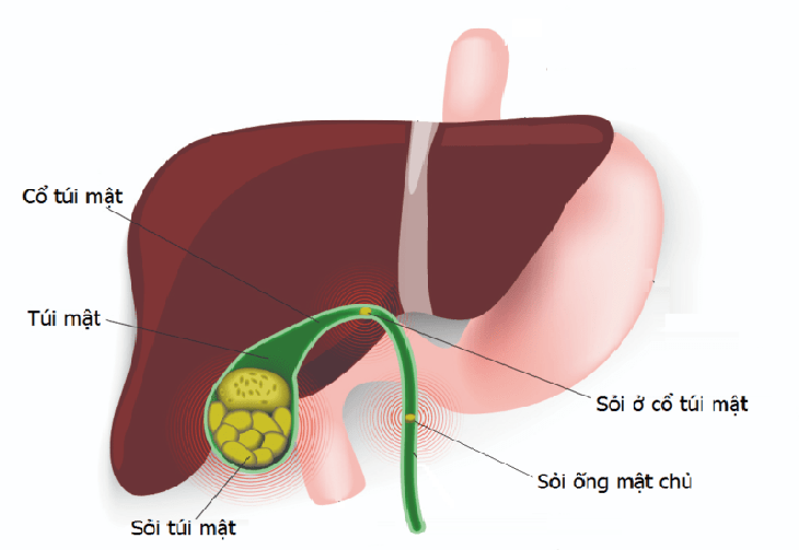 Sỏi túi mật và sau cắt túi mật có ảnh hưởng gì đến cuộc sống không? - Ảnh 1. Sỏi túi mật và sau cắt túi mật có ảnh hưởng gì đến cuộc sống không? - Ảnh 1.