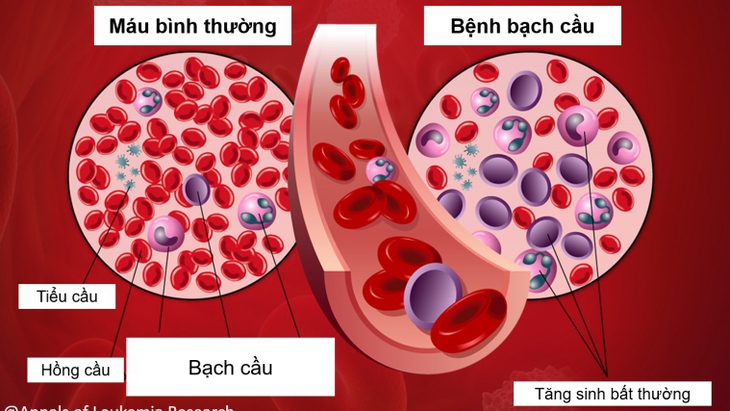 Hy hữu: Tình cờ phát hiện ung thư máu sau khi bị râu tôm chọc vào ngón tay  - Ảnh 1.
