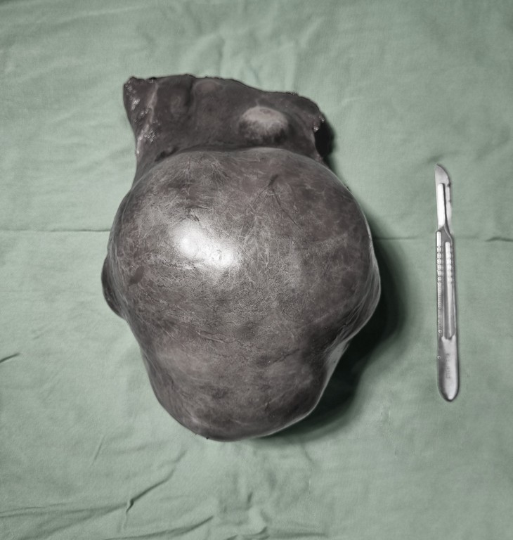 Cụ ông 73 tuổi mang trong mình khối u gan khổng lồ nặng 1,6kg

 - Ảnh 1.