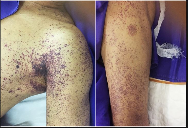 Mắc liên cầu khuẩn sau khi ăn lòng lợn, không ăn tiết canh vì sao? - Ảnh 1. Mắc liên cầu khuẩn sau khi ăn lòng lợn, không ăn tiết canh vì sao? - Ảnh 1.