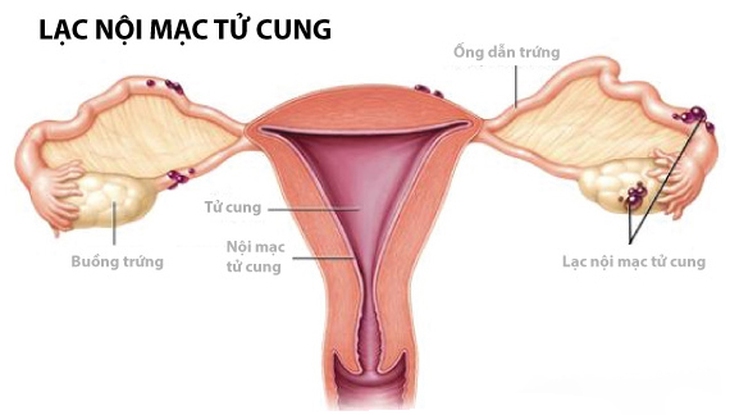 Dấu hiệu cảnh báo lạc nội mạc tử cung cần đi khám - Ảnh 2.