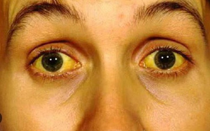 Nhiễm xoắn khuẩn Leptospira khi đi chơi thác nước: Dấu hiệu nhận biết và cách phòng tránh
