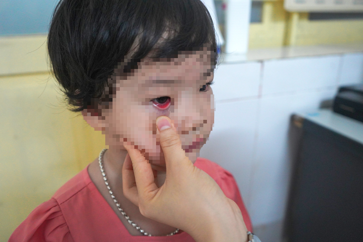 Nghệ An: Gia tăng bệnh nhi đau mắt đỏ, bác sĩ khuyến cáo cách phòng tránh - Ảnh 2. Nghệ An: Gia tăng bệnh nhi đau mắt đỏ, bác sĩ khuyến cáo cách phòng tránh - Ảnh 2.