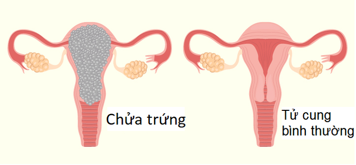 Chửa trứng có gây ung thư không? - Ảnh 2.